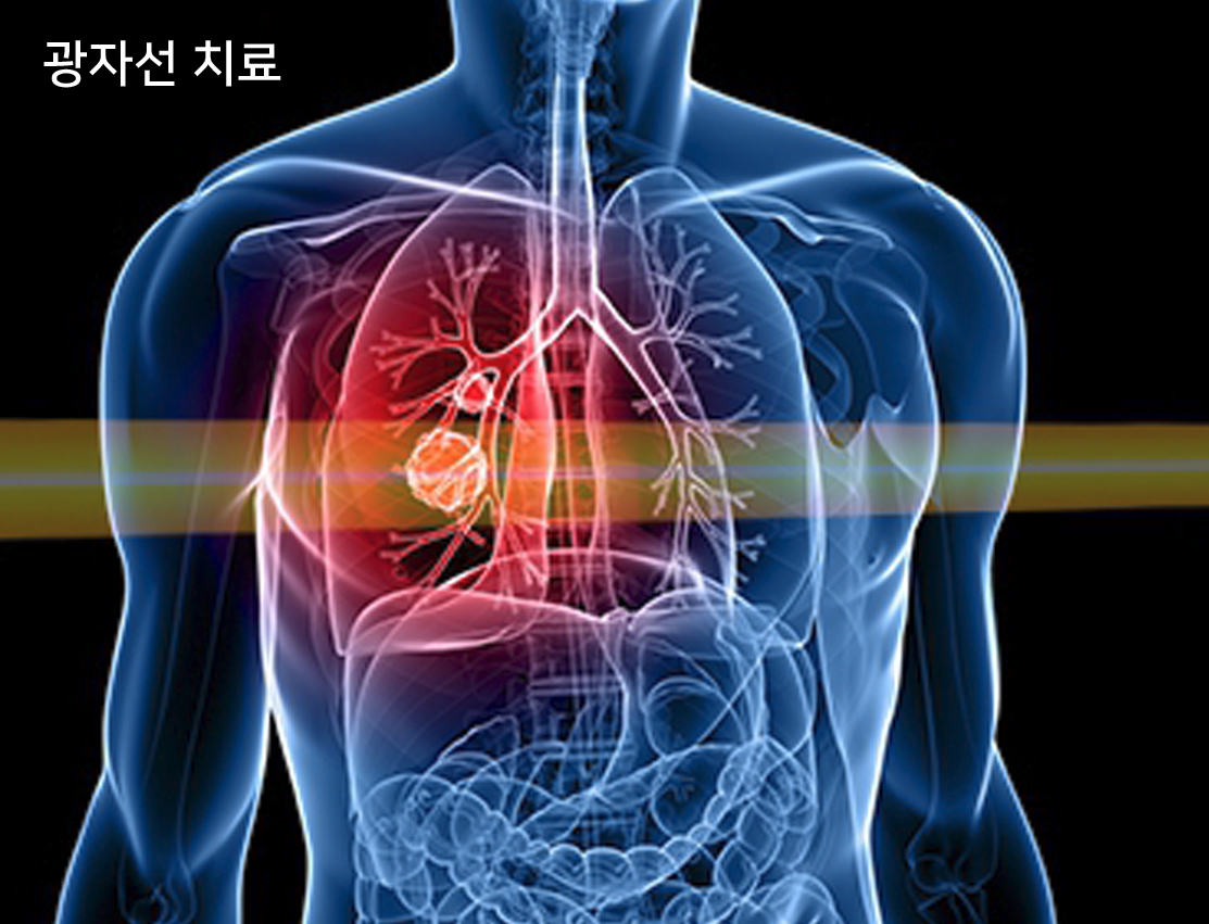 방사선의 종류에 따른 DNA 절단 차이
