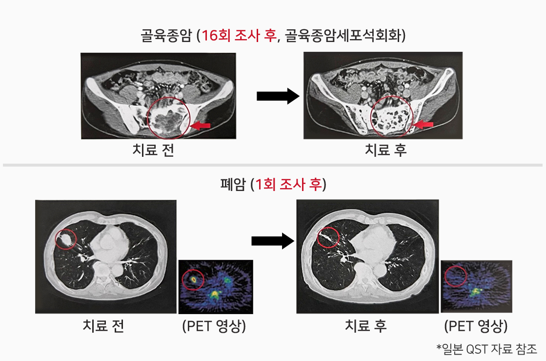중입자 치료 효과 사례(QST병원)